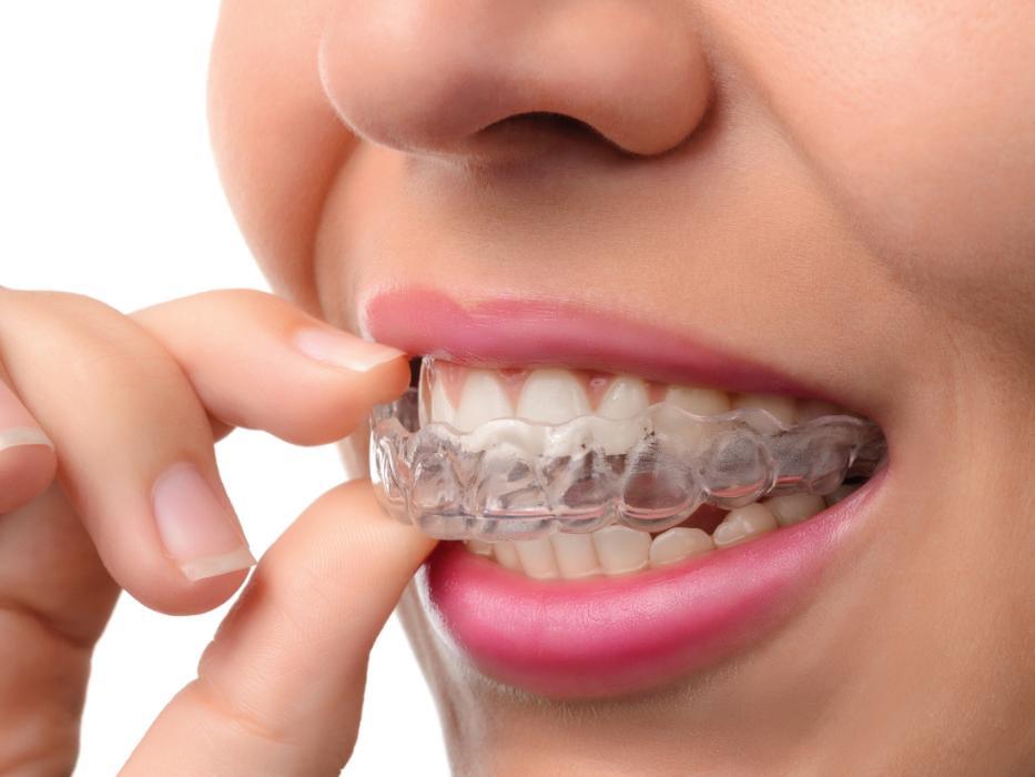 invisalign tray st. augustine, fl